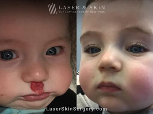 Pulsed Dye Laser to treat Hemangioma above Lip