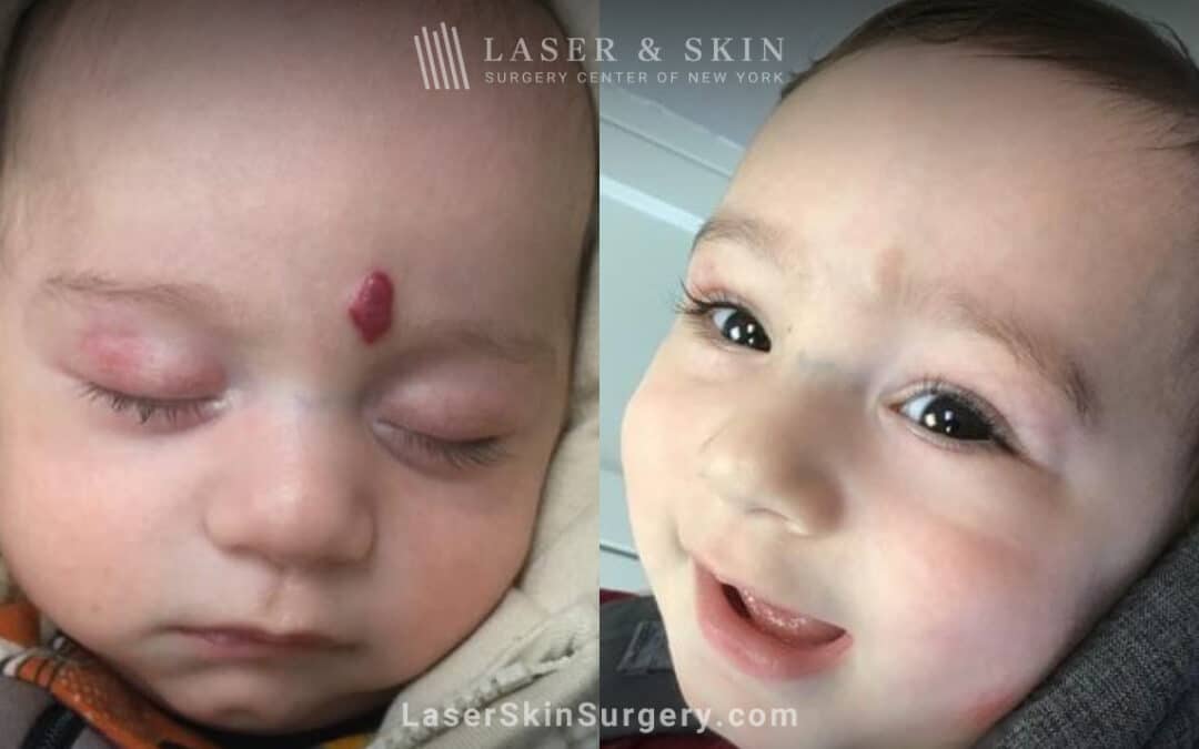 Pulsed Dye Laser to treat Hemangioma on Forehead