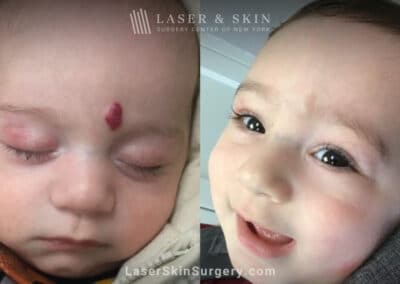 Pulsed Dye Laser to treat Hemangioma on Forehead