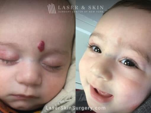 Pulsed Dye Laser to treat Hemangioma on Forehead