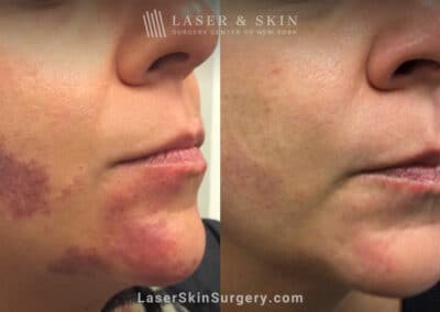 Pulsed Dye Laser to Treat Port Wine Birthmark