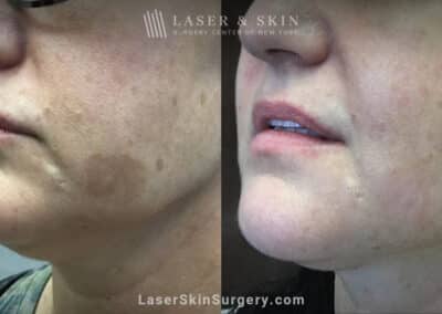 Ruby Laser to Treat Lentigo (Age Spot)