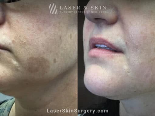 Ruby Laser to Treat Lentigo (Age Spot)