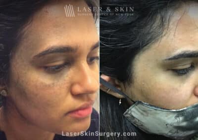 Ruby Laser to Treat Nevus of Ota