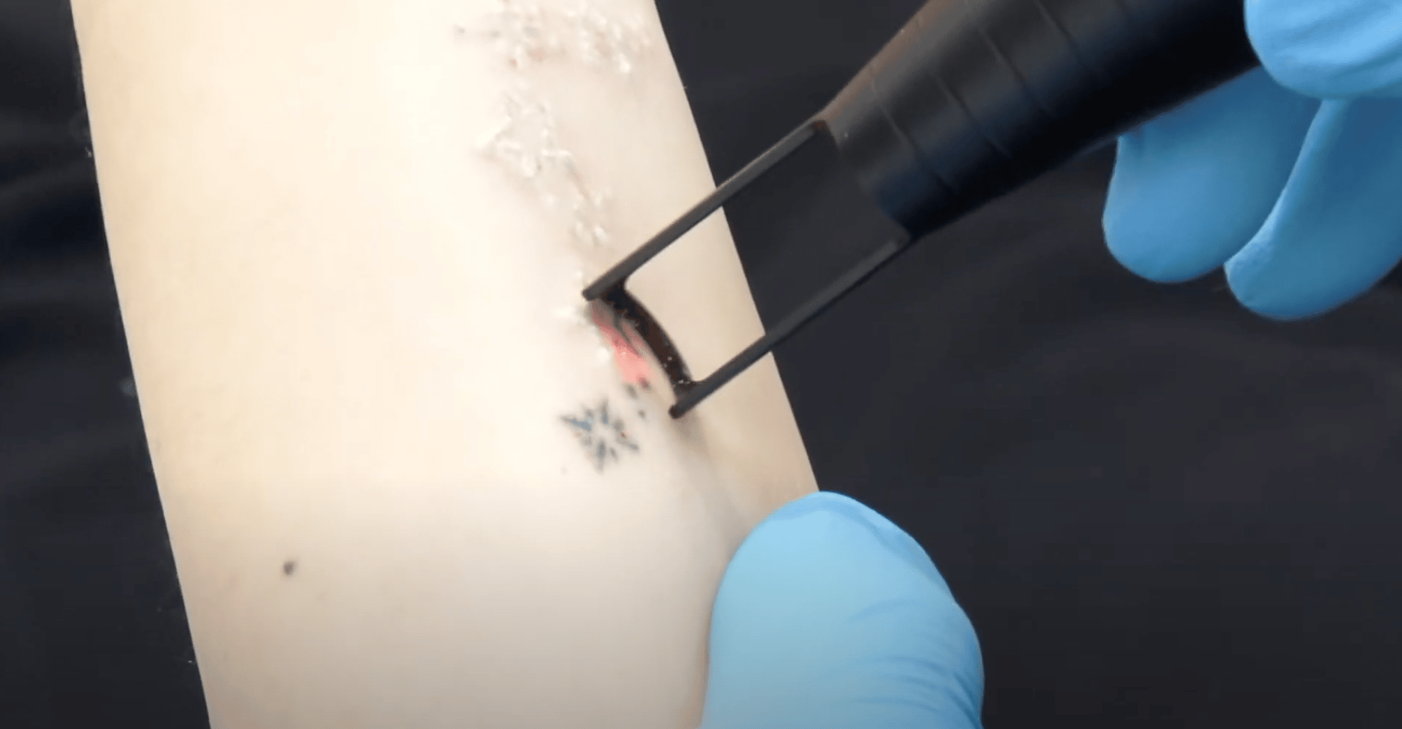 lsscny Laser tattoo removal procedure new york ny