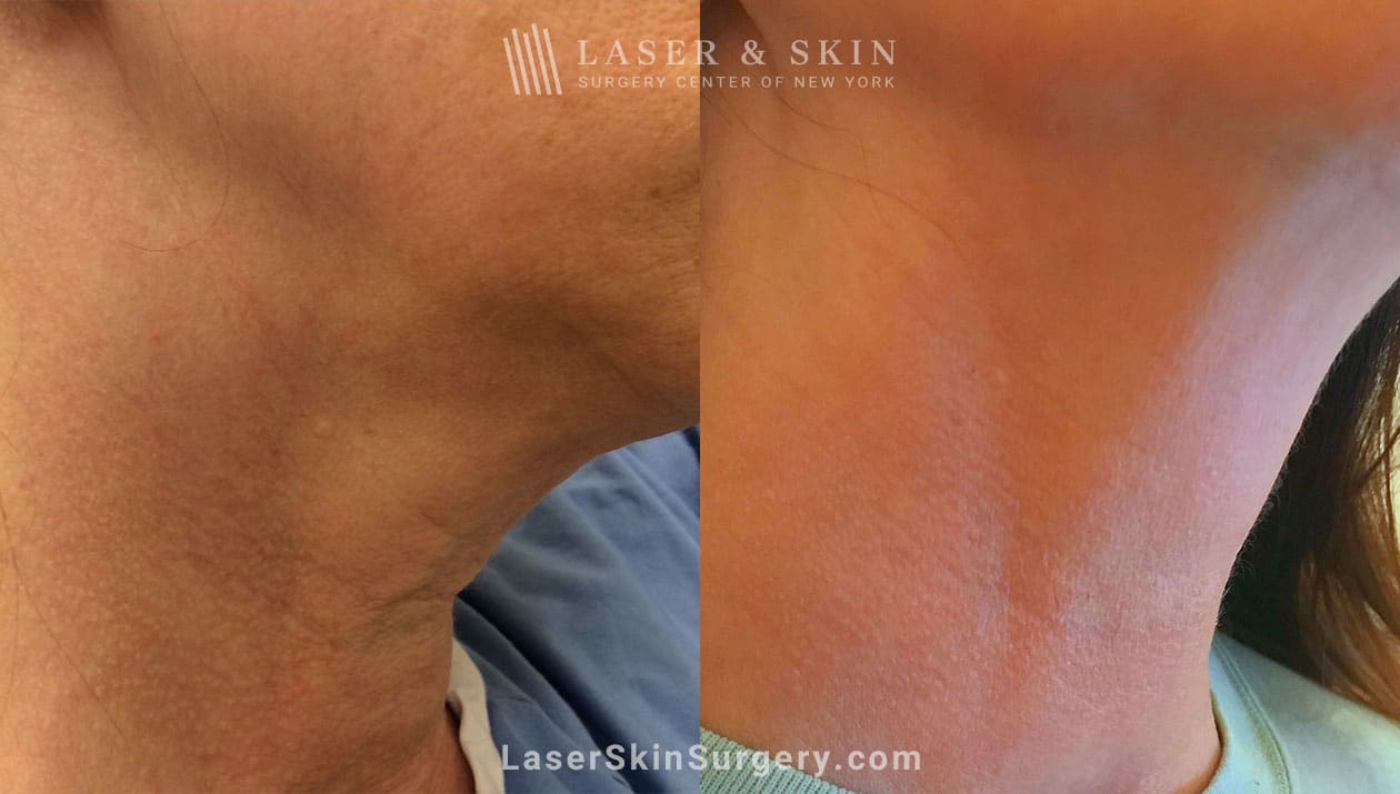 ThermiSmooth skin tightening results in NYC, NY