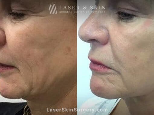 Ultherapy and Sofwave for skin tightening and wrinkle reduction