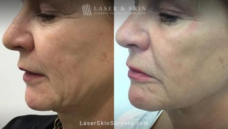 Ultherapy and Sofwave for skin tightening and wrinkle reduction