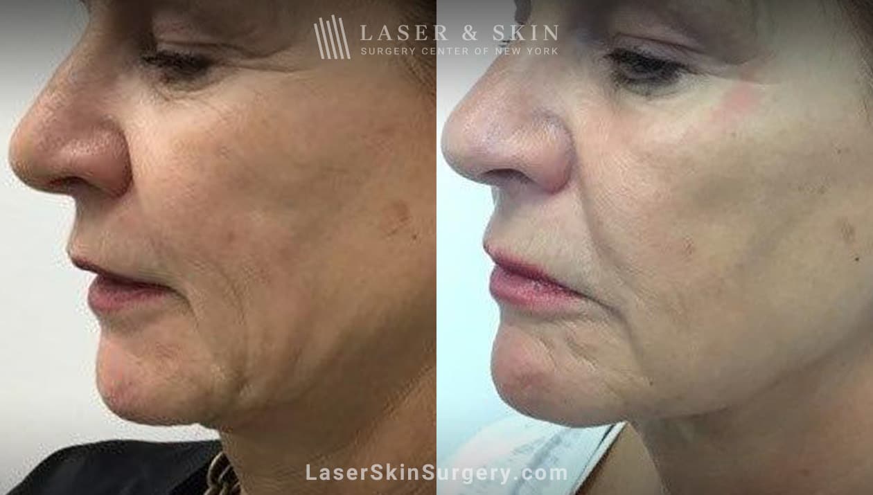 lsscny before and after image of an Ultherapy laser treatment for sagging skin and facial lines and wrinkles new york ny