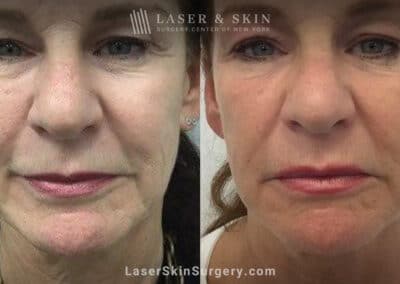 Ultherapy and Sofwave for skin tightening and wrinkle reduction