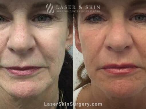 Ultherapy and Sofwave for skin tightening and wrinkle reduction