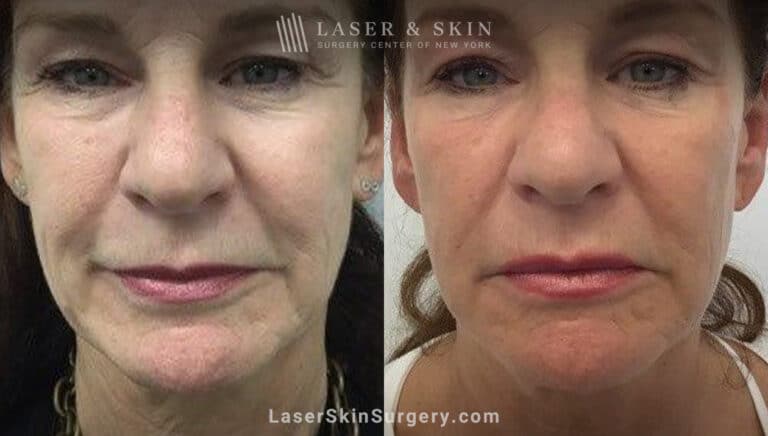 Ultherapy and Sofwave for skin tightening and wrinkle reduction