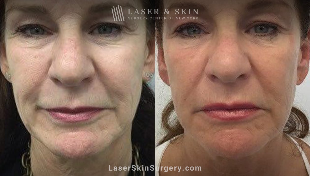 surgical facelift before and after