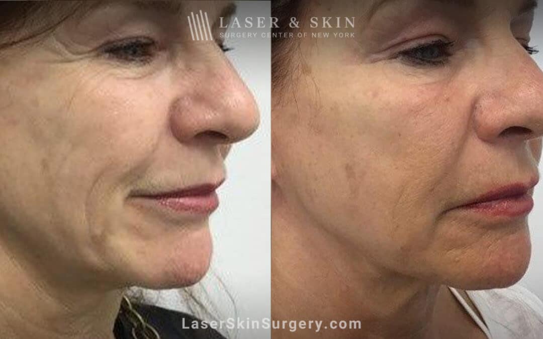 Ultherapy and Sofwave for skin tightening and wrinkle reduction