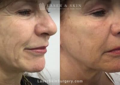 Ultherapy and Sofwave for skin tightening and wrinkle reduction