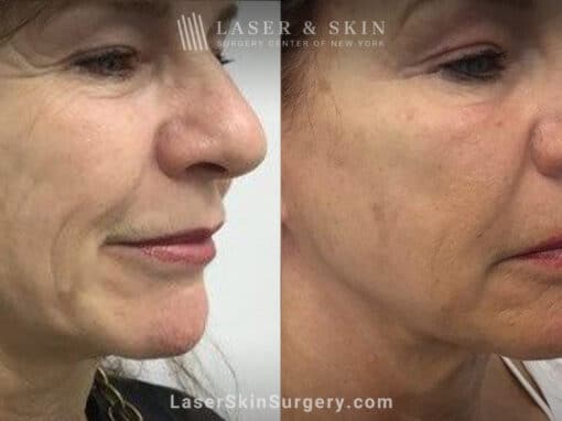 Ultherapy and Sofwave for skin tightening and wrinkle reduction