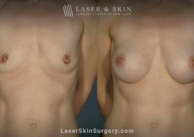 Breast augmentation to increase breast size