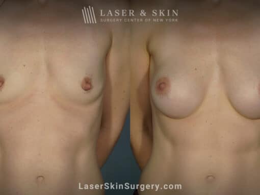 Breast augmentation to increase breast size