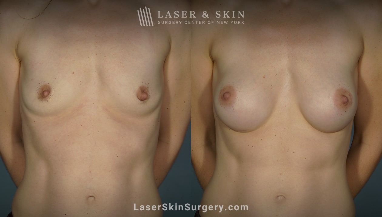 lsscny breast augmentation procedure new york, ny