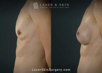 Breast augmentation to increase breast size