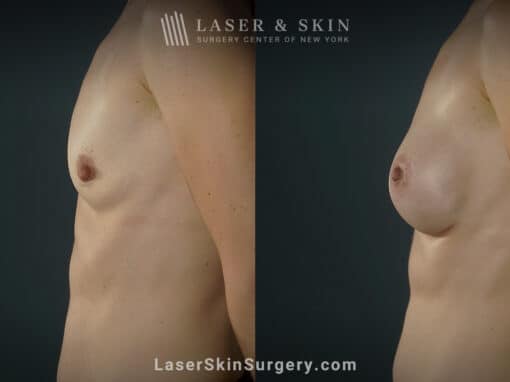 Breast augmentation to increase breast size