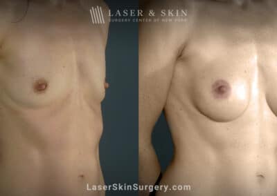 Breast augmentation to increase breast size