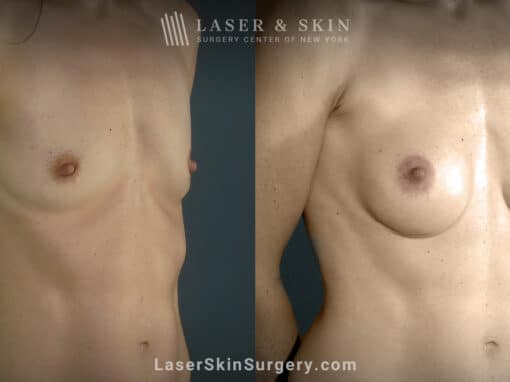 Breast augmentation to increase breast size