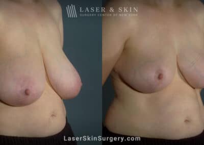 Breast reduction to create smaller breasts