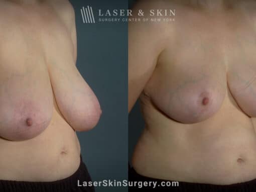 Breast reduction to create smaller breasts