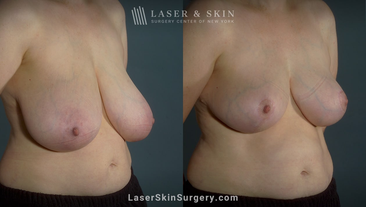 breast reduction results in nyc