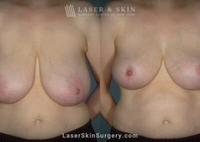 Breast reduction to create smaller breasts