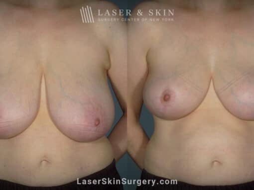 Breast reduction to create smaller breasts