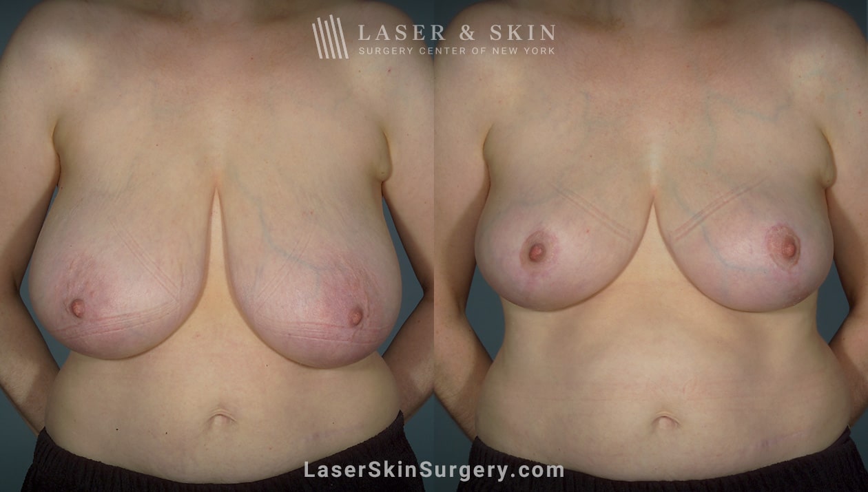 stock model photo for breast reduction surgery in New York