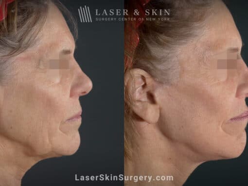 Facelift to refine jawline and rejuvenate appearance