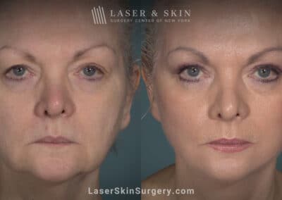 Facelift to rejuvenate the face and eliminate jowls