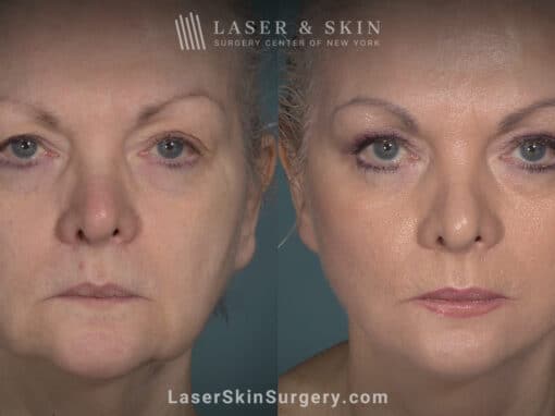 Facelift to rejuvenate the face and eliminate jowls