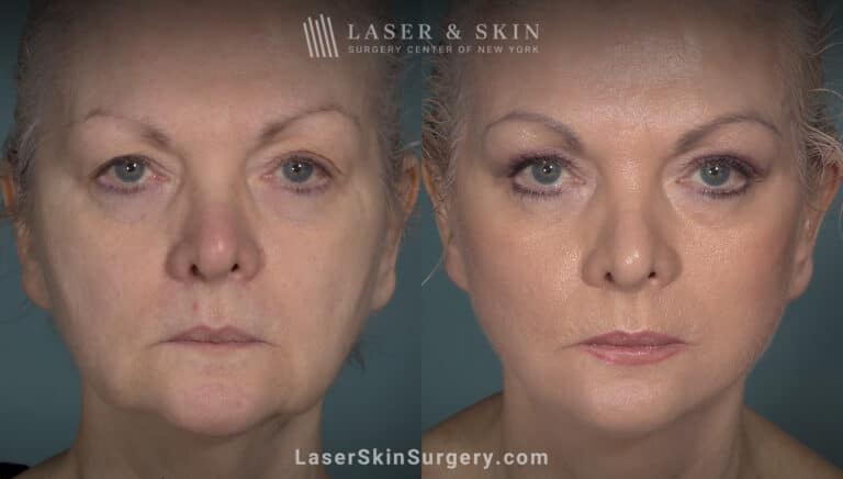 Facelift to rejuvenate the face and eliminate jowls