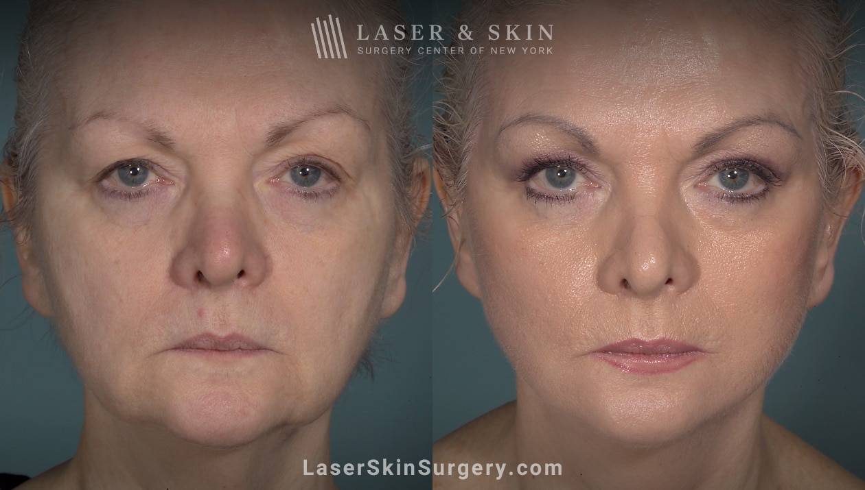 facelift patient