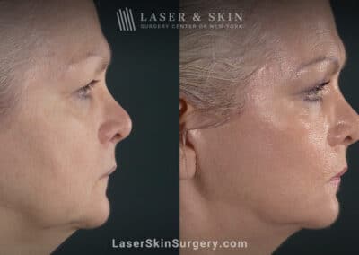 Facelift to rejuvenate the face and eliminate jowls