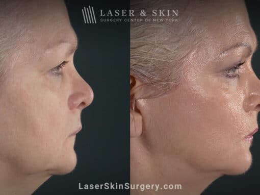 Facelift to rejuvenate the face and eliminate jowls