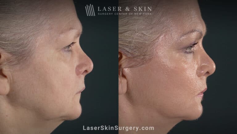 Facelift to rejuvenate the face and eliminate jowls