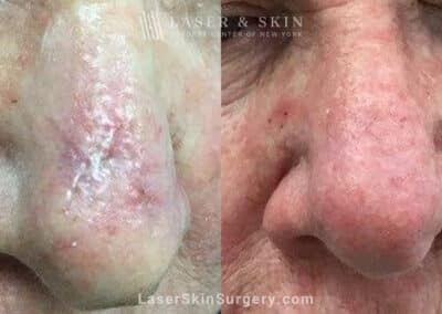 One Fraxel Dual treatment to reduce nose scar