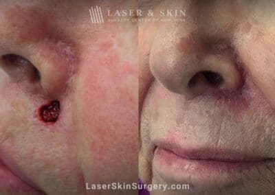 Mohs Surgery to Treat Skin Cancer by Nose