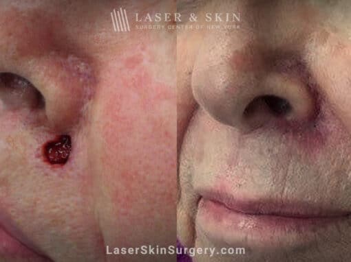 Mohs Surgery to Treat Skin Cancer by Nose