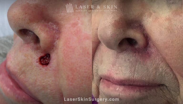 Mohs Surgery to Treat Skin Cancer by Nose