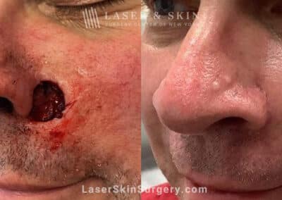 Mohs surgery to treat skin cancer next to nose