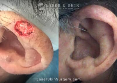 Mohs Surgery to Treat Skin Cancer on Ear