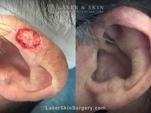 Mohs Surgery to Treat Skin Cancer on Ear