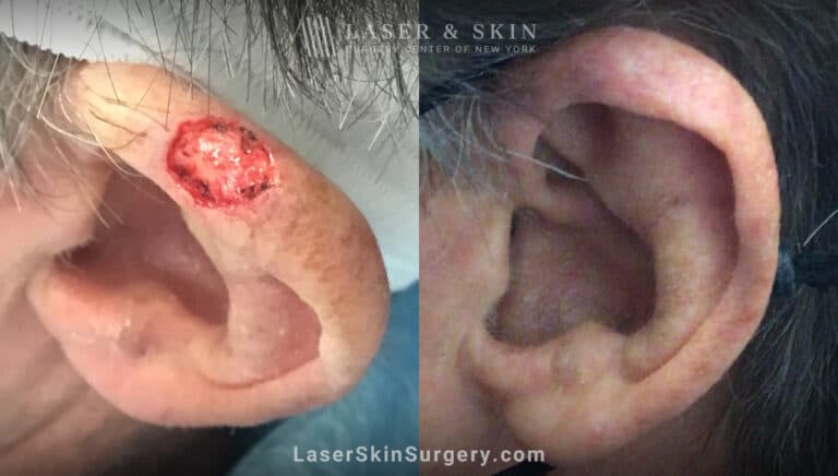 Mohs Surgery to Treat Skin Cancer on Ear