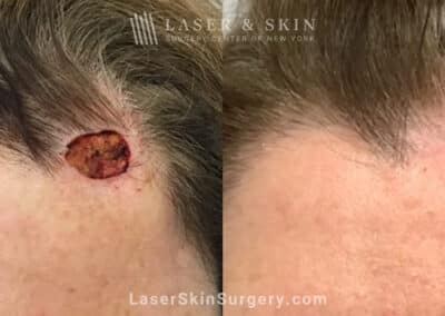 Mohs surgery to treat skin cancer on forehead